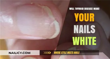 Thyroid Disease and Nail Health: Understanding White Nails and Symptoms