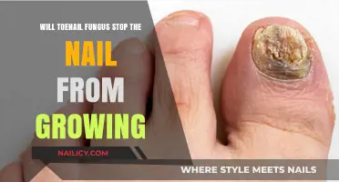Toenail Fungus: Can It Stop Nail Growth?