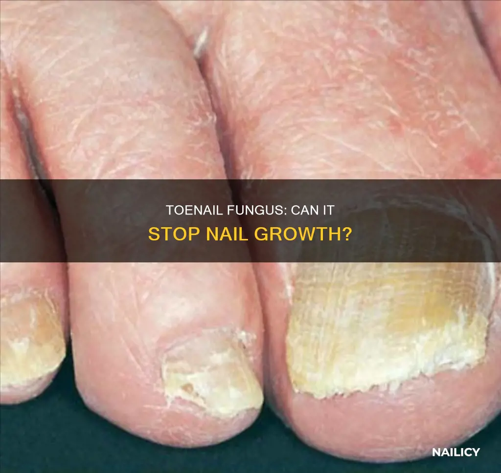 will toenail fungus stop the nail from growing