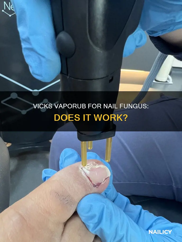 will vicks remove nail fungus
