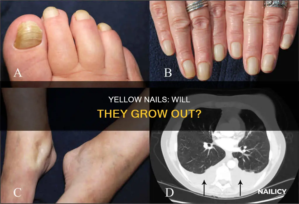 will yellow nails grow out