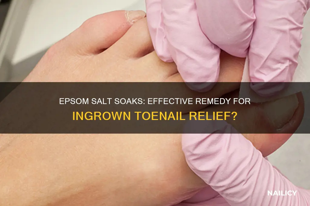 would epsom salts help an ingrown nail